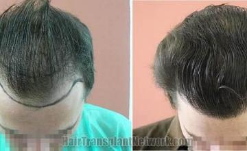 Hair transplantation surgery before and after pictures