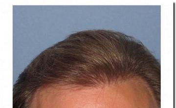 Hair restoration procedure results