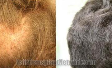 Back view before and after hair transplantation photos