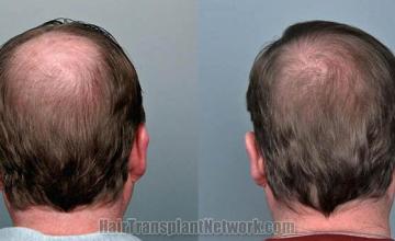 Hair restoration procedure before and after pictures