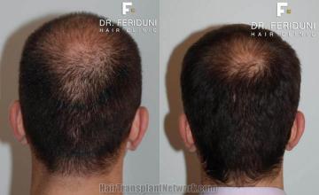 Back view before and after hair transplantation photos