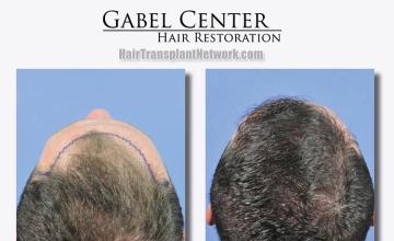 Back view before and after hair transplantation photos