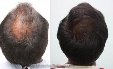 Hair transplantation surgery before and after pictures