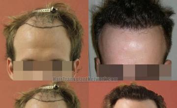 Hair transplantation surgery before and after images