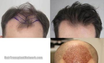 Hair restoration procedure before and after results