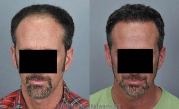 Hair restoration procedure before and after results