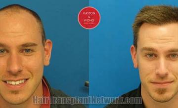 Hair restoration procedure before and after results