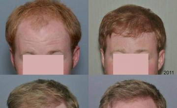 Hair restoration procedure before and after results