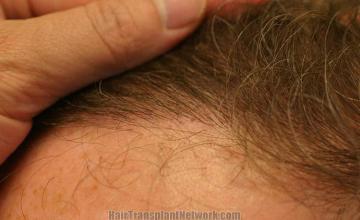 Hair transplantation surgery before and after pictures