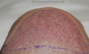 Hair replacement surgery before and after images