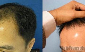 Hair restoration results after 10 months