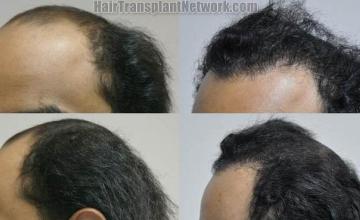 Hair transplantation surgery before and after images