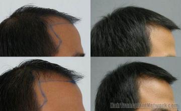 Thailand hair restoration procedure results