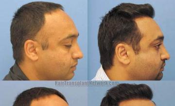 Hair transplant before and after pictures