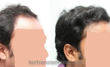 Hair restoration procedure before and after results