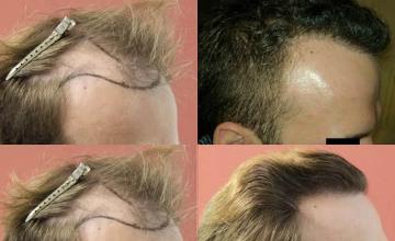 Hair restoration procedure before and after pictures