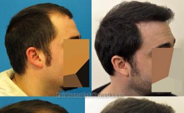 Hair restoration procedure before and after results