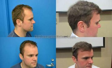 Hair restoration procedure before and after results