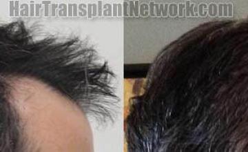 Hair transplantation surgery before and after images