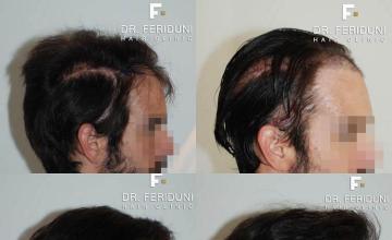 Hair transplantation surgery before and after images