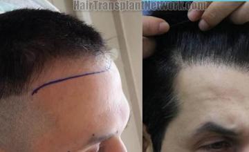 Hair transplantation surgery before and after photos