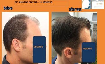 Hair transplantation surgery before and after images