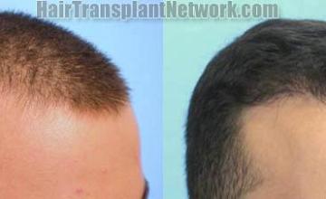 Hair transplantation surgery before and after pictures