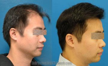 Hair transplantation surgery before and after photos