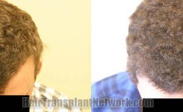 Hair transplantation surgery before and after photos