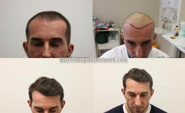 Hair transplantation surgery before and after photos