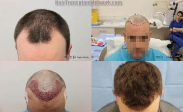 Top view - Before and after surgical hair replacement