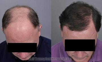 Hair transplantation surgery before and after photos