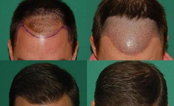 Hair transplantation surgery before and after photos