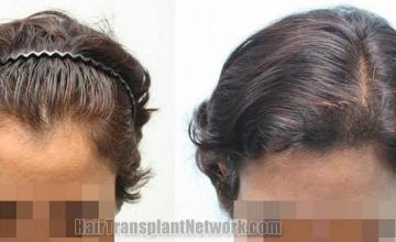 Hair transplantation surgery before and after photos