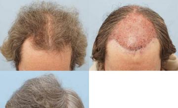 Hair restoration procedure before and after results