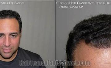 Hair restoration procedure before and after results