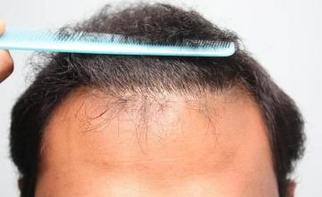 Hair transplantation surgery before and after photos