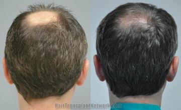 Back view before and after hair transplantation photos