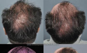 Hair restoration procedure before and after pictures