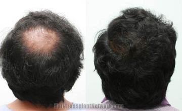 Hair transplantation surgery before and after images