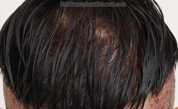 Hair restoration procedure before and after pictures