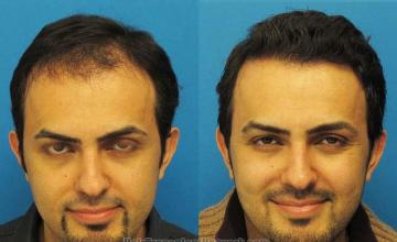 Hair restoration procedure before and after results