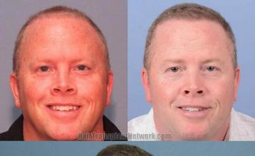 Hair restoration procedure before and after results