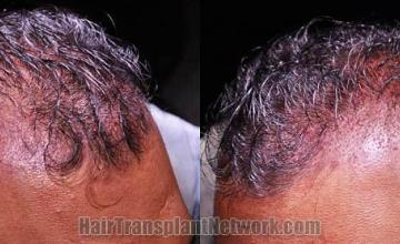 Hair transplantation surgery before and after pictures