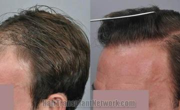 Hair transplantation surgery before and after images