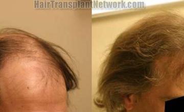 Hair restoration patient before and after images