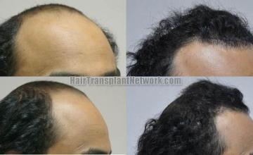 Hair restoration procedure before and after results