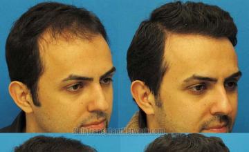 Hair transplantation surgery before and after images