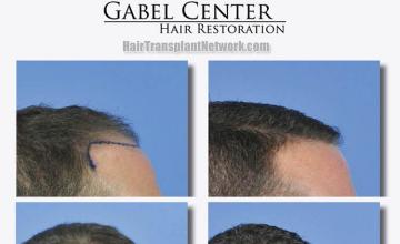 Before and after hair transplant procedure images