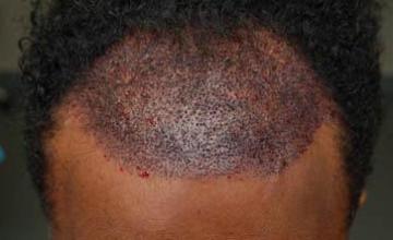 Hair transplant before and after photos